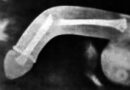 fracture pénis